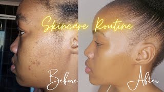 My skincare routine for acne  Under R50  South African YouTuber [upl. by Cyma535]