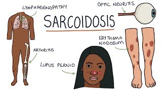 Understanding Sarcoidosis A Visual Guide for Students [upl. by Rramaj]