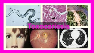 toxocariasis [upl. by Enomys945]