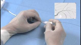 Angioplasty technique manipulation of a guide wire [upl. by Ahsa]