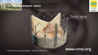 Transcatheter Aortic Valve Implantation Transfemoral Approach TAVI Hindi  CIMS Hospital [upl. by Enneirdna]