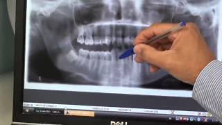 Periodontitis Tratarla a tiempo vital para salvar nuestros dientes [upl. by Lleon]