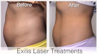 EXILIS  Body Contouring amp Skin Tightening [upl. by Tfat]