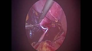 Dr Kerkeni  Laparoscopic pyeloplasty and renal cyst [upl. by Aiyram]