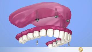 Implantologie Fester Zahnersatz mit AllOn4Implantat im Oberkiefer [upl. by Kallista632]