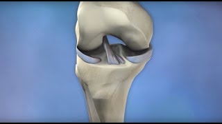 ACL Injury Prevention  Mayo Clinic [upl. by Iasi]