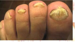 fungus toenail [upl. by Selrhc]