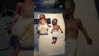 Twins  Twin Pregnancy  Babies in the womb  Multiple Pregnancy shortsfeed twins baby fyp [upl. by Naugan]