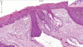 HSIL  High Grade Squamous Intraepithelial Lesion  Histopathology [upl. by Avalsorim]