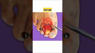 foot care🦶🏻  medical satisfying footcare medicalstudent shorts [upl. by Ridinger]