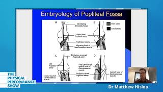 POPLITEAL ARTERY ENTRAPMENT SYNDROME 319 Dr Matthew Hislop Sport amp Exercise Medicine Physician [upl. by Deonne]