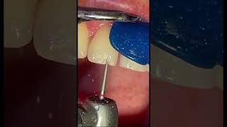 Fixing chipped tooth with composite bonding at the dentist [upl. by Stephen418]