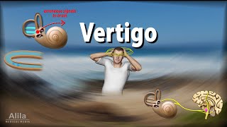 Vertigo Causes Pathophysiology and Treatments Animation [upl. by Salokcin]