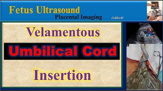 Fetus Ultrasound Velamentous Umbilical Cord Insertion [upl. by Viva]