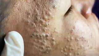 Big Cystic Acne Blackheads Extraction Blackheads amp Milia Whiteheads Removal Pimple Popping 033 [upl. by Trebornhoj941]