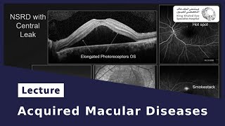 Acquired Macular Diseases [upl. by Maureen694]