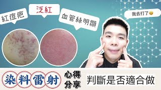 紅痘疤剋星！臉紅必看「染料雷射」心得分享：痛嗎？值得做嗎？ Bolow 菠蘿 [upl. by Gaul]