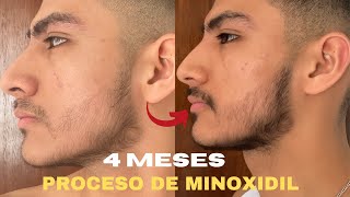 4 MESES USANDO MINOXIDIL PARA CRECER BARBA SIENDO 100 LAMPIÑO [upl. by Dickson240]