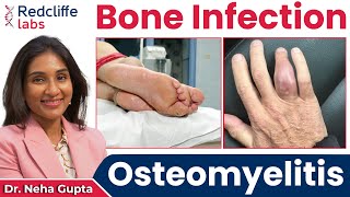 💹 What is Osteomyelitis Osteomyelitis Bone Infection Symptoms Causes And Treatment  Redcliffe [upl. by Frederic]