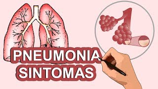 PNEUMONIA SINTOMAS [upl. by Tucky]