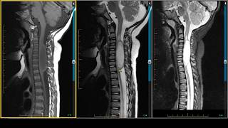 Cervical Spinal Cord Astrocytoma on MRI [upl. by Hanikas]