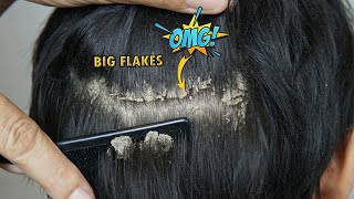 4 SECRET Tips To Remove Dandruff Forever  BeerBiceps Health [upl. by Chicoine]