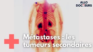 Métastases quelle prise en charge   Allo Docteurs [upl. by Eimareg]