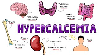 An Approach to Hypercalcemia  Causes Calcium Homeostasis Mechanisms amp Signs and Symptoms Mnemonic [upl. by Ahsiekim318]