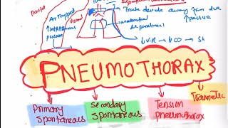 Pneumothorax Types and Treatment Respiratory 46  First Aid USMLE Step 1 in UrduHindi [upl. by Quinby]