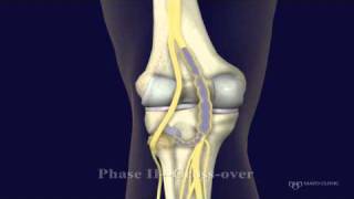 Peroneal and Tibial Intraneural Ganglion Cysts in the Knee Region Video 2 [upl. by Blackington]