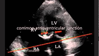 PARTIAL ATRIOVENTRICULAR CANAL WITH OSTIUM SECUNDUM ATRIAL SEPTAL DEFECT IN A DOG [upl. by Aicire934]