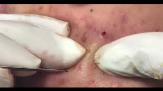 30 MINUTES OF EXTRACTING ACNE [upl. by Sonafets]