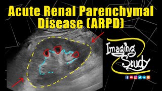 Acute Renal Parenchymal Disease  Ultrasound  Case 333 [upl. by Bicknell]