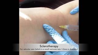 Sclerotherapy for varicose vein  Live sclerotherapy video [upl. by Lorraine]