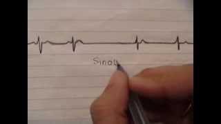 ECG simplified  Sinoatrial block [upl. by Odette]