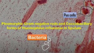 Haemophilus influenzae in Sputum  Coccobacillary forms of Haemophilus influenzae [upl. by Vigen344]