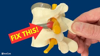 How to Relieve Herniated Disc Pain in SECONDS [upl. by Eilime]