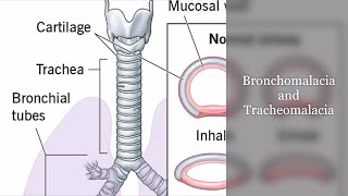 Bronchomalacia and Tracheomalacia [upl. by Clements]