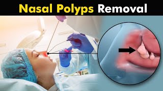 Nasal Polyps and their treatment  How Polypectomy is Performed [upl. by Burlie945]