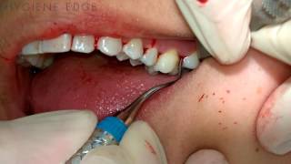 Gracey Instrumentation During Periodontal Therapy [upl. by Alvan]