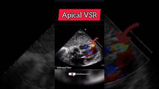 Post MI apical Ventricular Septal Rupture VSR on Echocardiography cardiology heart [upl. by Annhoj510]