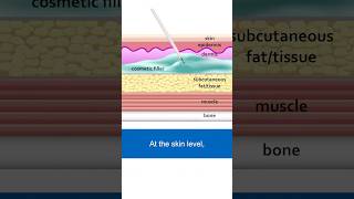 Facial Fillers Comparing SkinLevel vs BoneLevel Placement dermalfillers [upl. by Ainevul364]