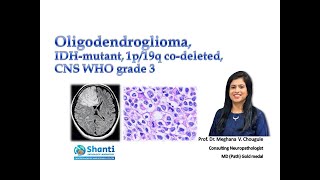 Oligodendroglioma IDH1mutant 1p19q codeleted [upl. by Liggett]