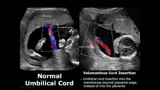 Umbilical Cord Ultrasound Normal Vs Abnormal Image Appearances Comparison  Fetal USG  Obstetric [upl. by Ecneralc583]