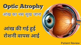 Optic Atrophy आंख का नस सूख जाना   Ayurveda Eye treatments [upl. by Lenaj]