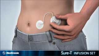 How to insert the Medtronic MiniMed SureT infusion set  diabetes therapy [upl. by Lladnar]