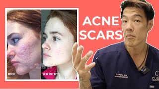 The Best Acne Scar Treatments Explained  Dr Davin Lim [upl. by Aihsena334]