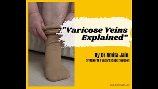 Varicose Veins Symptoms Treatments amp Expert Advice from Delhi NCRs Top Surgeon Dr Amita Jain [upl. by Yednarb612]