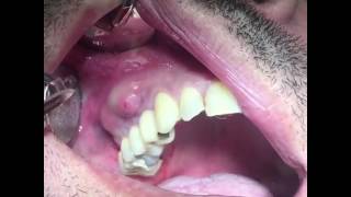 Dental Abscess Drainage by Dentist [upl. by Ameline]