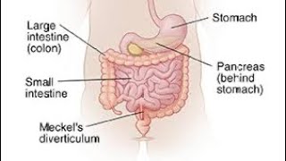 Mcqs on Meckel’s diverticulum surgerysurgeryeducationneetpg [upl. by Aikkin]